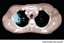 A CT scan of the chest axial section showing lung cancer. According to a recent Archives of Internal Medicine paper, radiation from CT scans are responsible for 1.5% to 2% of all cancers in U.S. patients.