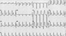 How is Acute Pericarditis Diagnosed and Treated? | The ...