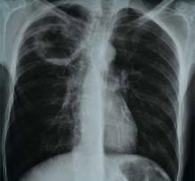 What Is the Best Approach to a Cavitary Lung Lesion?