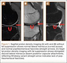 Wrisberg-Variant Discoid Lateral Meniscus: Current Concepts, Treatment ...