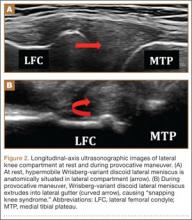 Wrisberg-Variant Discoid Lateral Meniscus: Current Concepts, Treatment ...