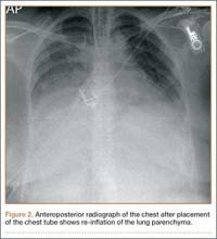 Tension Pneumothorax After Ultrasound-Guided Interscalene Block and ...