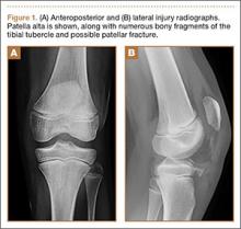 Combined Tibial Tubercle Avulsion Fracture and Patellar Avulsion ...