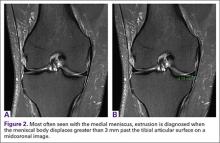 Meniscal Root Tears: Identification and Repair | MDedge Surgery