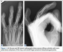 Silicone Arthroplasty After Ankylosis of Proximal Interphalangeal ...