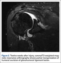 Successful Nonoperative Management of HAGL (Humeral Avulsion of ...