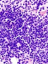 Micrograph showing multiple myeloma