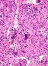 Primary myelofibrosis