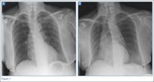 Emergency Imaging: Shortness of breath | MDedge Emergency Medicine