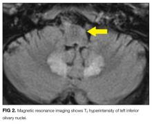 Magnetic resonance imaging shows T2 hyperintensity of left inferior olivary nuclei.