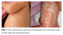 Fine, erythematous, blanching maculopapular rash