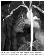 Tortuous and aneurysmal dilation of the right proximal brachial artery