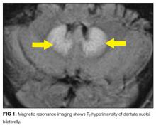 Magnetic resonance imaging shows T2 hyperintensity of dentate nuclei bilaterally.