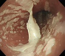 Endoscopy shows longitudinal sloughing mucosal casts in the middle and lower esophagus