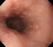 Complete healing of the esophageal mucosa 1 month later