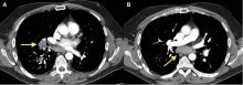 Figure 1. (A) An enlarged lymph node (2.4 cm × 2.0 cm) at the bifurcation of the bronchus intermedius. (B) An enlarged inferior mediastinal lymph node (2.0 cm × 5.4 cm).