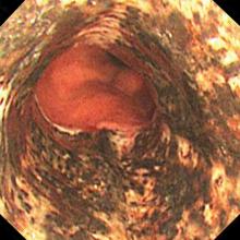 Figure 1. Upper endoscopy on the day of admission showed diffuse black discoloration of the esophageal mucosa affecting the distal esophagus and stopping abruptly at the gastroesophageal junction.