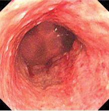 Figure 2. Upper endoscopy repeated 14 days after admission showed improvement of the mucosal lesions and esophagitis.