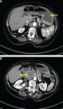 Figure 1. Computed tomography of the abdomen in the axial plane shows gastric distention (A, arrow) and a 3.9-cm mass at the pancreatic head, with compression of the descending duodenum (B, arrow), resulting in gastric outlet obstruction.