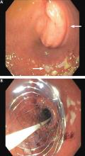 Figure 2. Esophagogastroduodenoscopy (A) shows a large submucosal mass in the duodenal bulb (upper arrow), with localized erosions (lower arrow). The obstruction was successfully opened (B) with a 22-mm × 12-cm WallFlex stent (Boston Scientifi c). 