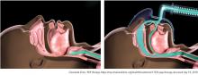 Figure 1. Obstructed airway (left) is opened with a column of air delivered using positive airway pressure therapy (right).