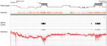 Figure 3. Sleep study overview showing rapid eye movement sleep (arrow/black bar) associated with increased arousals and apneic events and decreased oxygen levels.