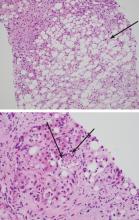 Figure 2. Transjugular biopsy study (top) shows severe steatosis from lipid accumulation in hepatocytes (arrow). Higher magnification (bottom) shows inflammatory cells (neutrophils, arrows) surrounding Mallory-Denk bodies.