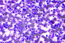 This is a micrograph of a diffuse large B cell lymphoma.