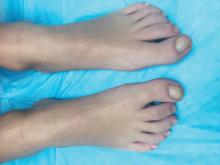 Congenital malalignment of the great toenails is shown in a child.