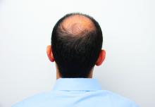 Rear view of a male head with thinning hair or alopecia