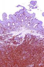 Intermediate magnification micrograph of mantle cell lymphoma of the terminal ileum.