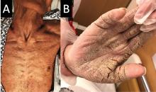 Figure 1. The hyperkeratotic lesions covered the trunk (A), arms, and hands (B).