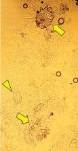 Figure 2. Microscopic study of hyperkeratotic lesion scrapings revealed scabies mites (arrows) and eggs (arrowhead).