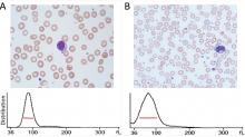 Example of normal red blood cell distribution width (RDW) of 13.5% (red line) in a patient with a normal complete blood cell count. B: Example of an increased RDW of 28.8% in a patient with iron deficiency shortly after initiation of iron supplementation.