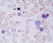 Giant platelets (thin arrows), normal sized platelets (dotted arrows), and a nucleated red blood cell (thick arrow) in a patient with myelofibrosis and extensive extramedullary hematopoiesis.