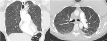 Figure 1. Computed tomography of the chest showed innumerable, diffuse micronodules in a centrilobular pattern.