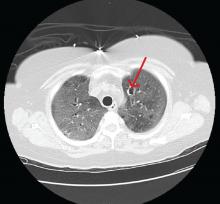 Computed tomography of the lungs showed a cystic lesion in the left upper lobe (arrow), with diffuse ground-glass opacities throughout.