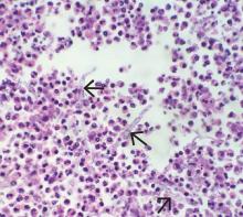 Study of a bowel specimen showed the typical “tree-branch” structures (arrows) of fungal hyphae (hematoxylin and eosin, × 600).