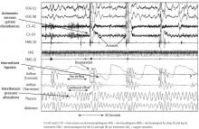 Figure 1. A polysomnogram showing autonomic nervous system disturbances, intermittent hypoxia, and intrathoracic pressure alterations.