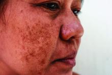 A person with melasma.
