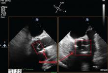 Figure 1A. Transesophageal echocardiography in a 73-year-old man with a bioprosthetic aortic valve who presented with 2 months of fevers, chills, and night sweats. 