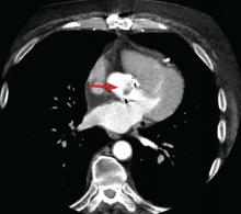 Figure 1B. Cardiac computed tomographic (CT) angiography with iodinated contrast, including 4D reconstruc-tion, in the same patient, however, shows an 11-mm vegetation on the bioprosthetic aortic valve leaflets (arrow).