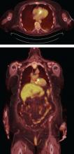 Figure 1C. Fluorodeoxyglucose positron emission tomography (FDG-PET) in the same patient confirms the diagnosis, showing a 13-mm hypermetabolic focus on the prosthetic valve (arrow), yielding the diagnosis of infectious endocarditis.