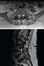 Figure 1. Magnetic resonance imaging of the lumbar spine with contrast showed cauda equina enhancement at level L5 to S1 (arrows) in axial T1 sequence (top) and sagittal T1 sequence (bottom).