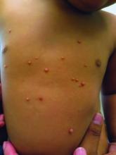 Pediatric molluscum contagiosum