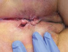 Figure 2. A linear ulcer with sharply demarcated borders in the gluteal cleft in another patient.