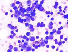 Histopathologic image of multiple myeloma. Smear preparation of bone marrow aspirate stained with May-Grünwald-Giemsa procedure.