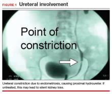 Genitourinary endometriosis: Diagnosis and management | MDedge