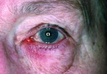 A patient with ocular rosacea.