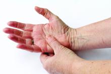 Hands with osteoarthritis